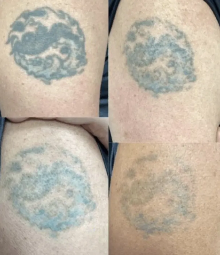 Round black and blue upper arm tattoo fading over four stages of laser tattoo removal