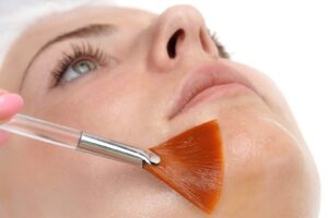 Peel solution brushed onto a cheek