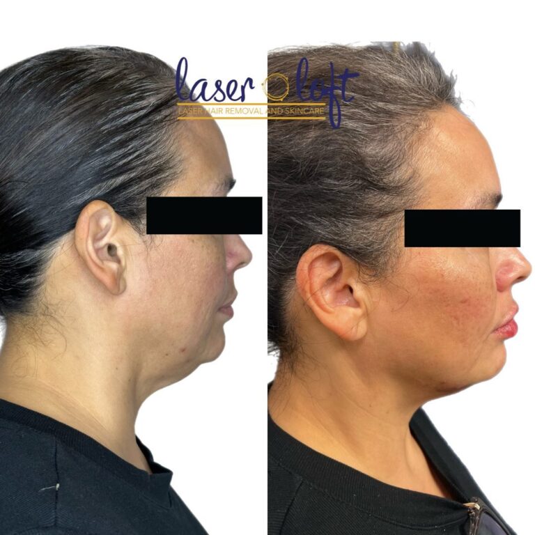 Side profile before and after chin filler, with a stronger chin and a smoother line from chin to neck