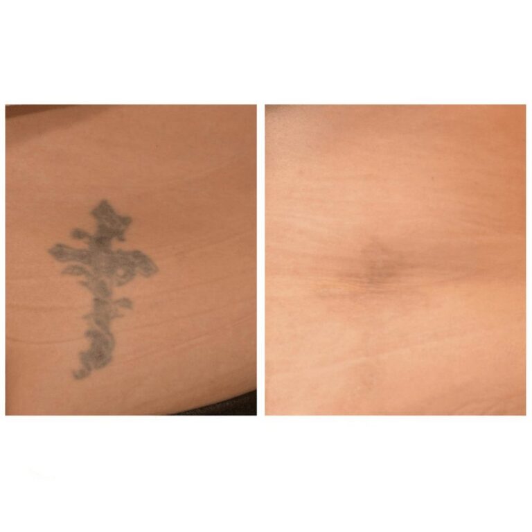 Cross tattoo on the hip before and after laser tattoo removal