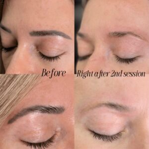 Dark eyebrow tattoos before and right after a second laser tattoo removal session