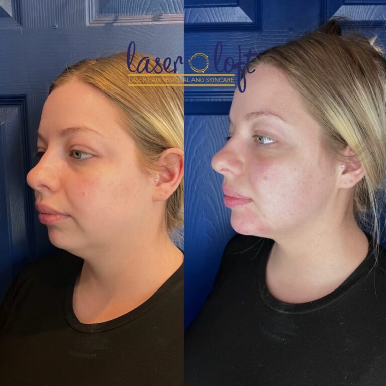 Three-quarter view of the chin and jawline before and after dermal filler, with a firmer, more defined jawline