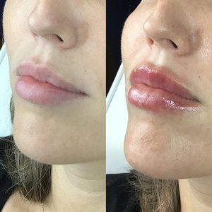 Lips before and after dermal filler, fuller and smoother after