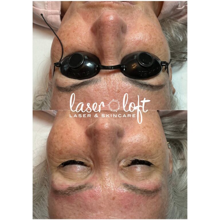 Cosmetic eyebrow tattoos before and after laser tattoo removal, seen from above