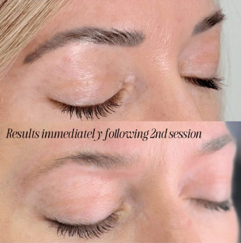 Close-up of a cosmetic eyebrow tattoo before and right after a second laser tattoo removal session