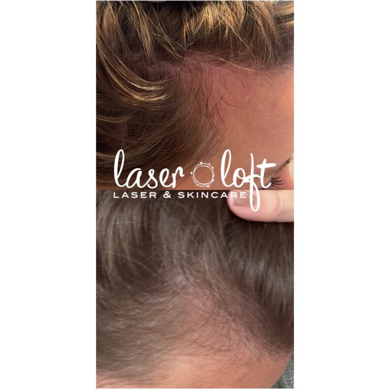 Thinning hair at the temple before, and thicker, denser hair in the same spot after scalp microchanneling