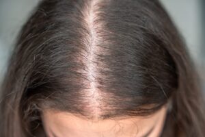 Scalp at the part line showing thinning