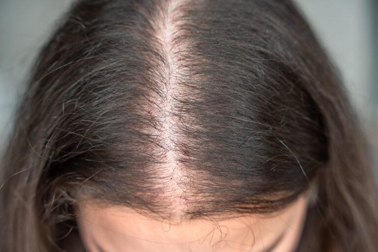 Scalp at the part line showing thinning