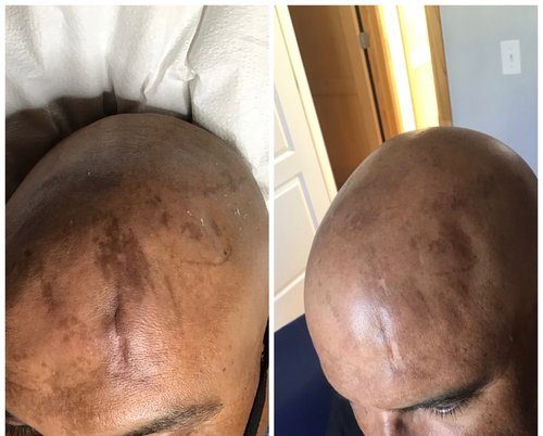 Dark patches of hyperpigmentation on a shaved scalp before, and a lighter, more even tone after pigment removal