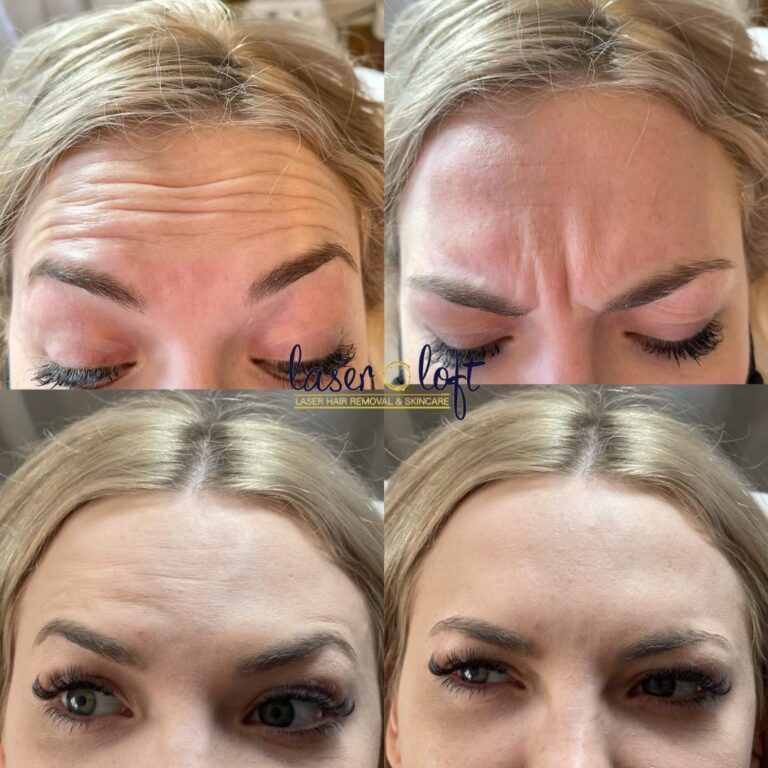 Forehead lines and frown lines before, and a smooth forehead making the same expressions after neurotoxin injections