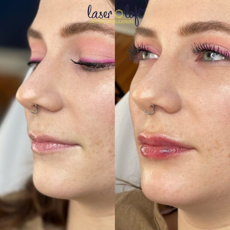 Three-quarter view of the lips before and after lip filler, fuller and more even after