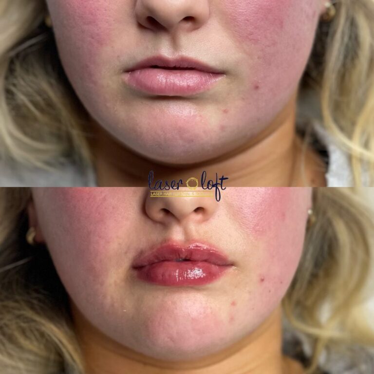 Front view of the lips before and after lip filler, with more volume and a clearer lip shape
