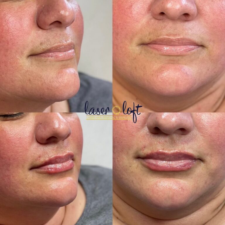 Lips from the side and the front before and after lip filler, subtly fuller after
