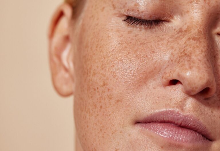 Sun-damaged cheek with freckling