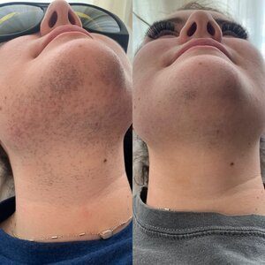 Stubble under the chin and along the jaw before, and far less hair after laser hair removal