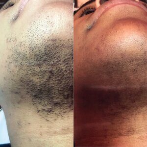 Dense dark hair under the chin and on the neck before, and much sparser regrowth after laser hair removal