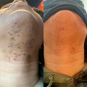 Bumps and ingrown hairs under the chin before, and clearer, smoother skin after laser hair removal