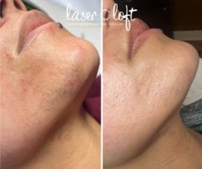 Stubble along the jaw and chin before, and smoother, near hair-free skin after laser hair removal