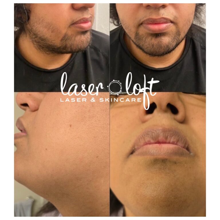 A full beard on the cheeks and chin before, and smooth, hair-free skin after laser hair removal