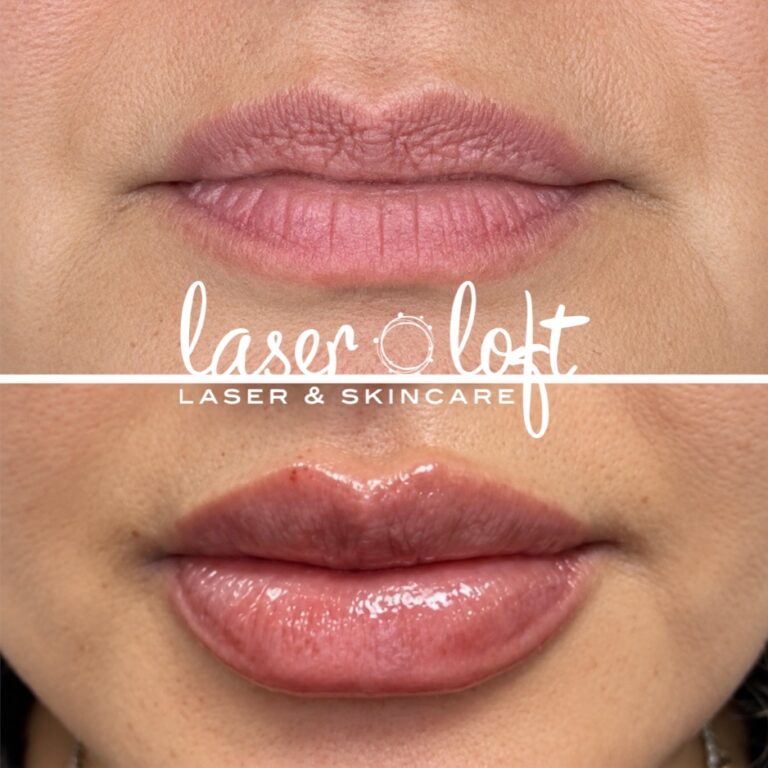 Front view of the lips before and after lip filler, fuller with a sharper cupid's bow