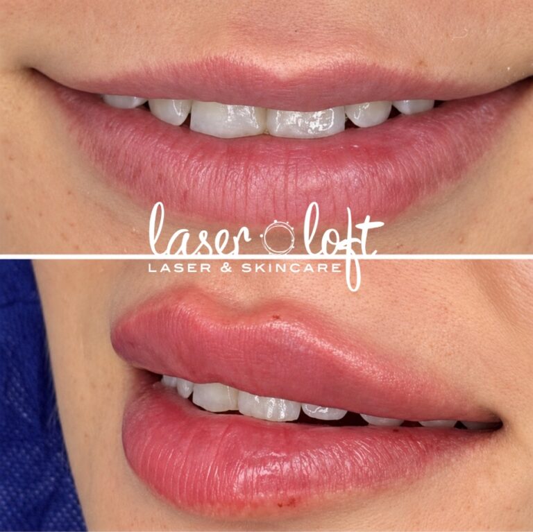 Smiling lips before and after lip filler, with a fuller upper lip that shows more in a smile