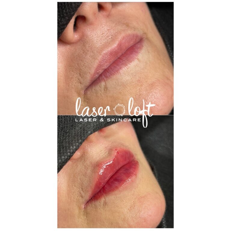 Angled view of the lips before and straight after lip filler, plumper top and bottom