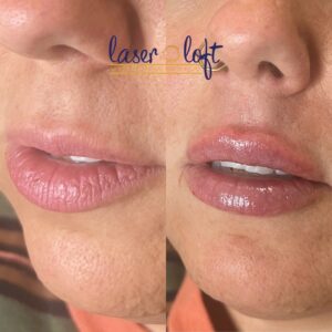 Close-up of thin, lined lips before, and smoother, fuller lips with a defined upper lip after lip filler