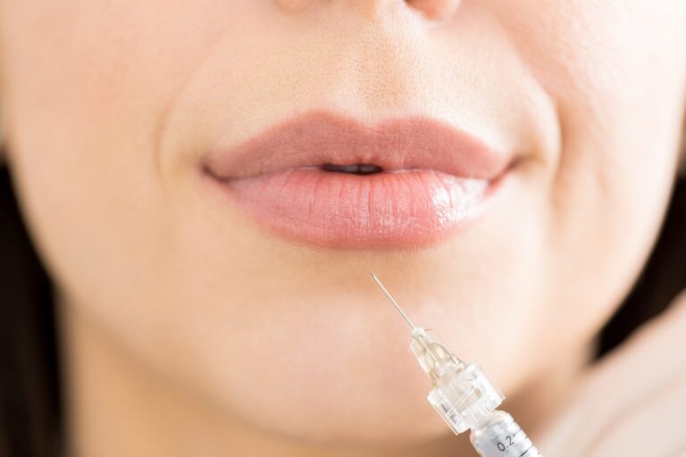 Natural lips after filler