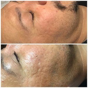 Acne-scarred cheek before, and a smoother, more even cheek after microchanneling with Venus Viva