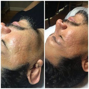 Pitted acne scars on the cheek and temple before, and softer scarring after microchanneling with Venus Viva