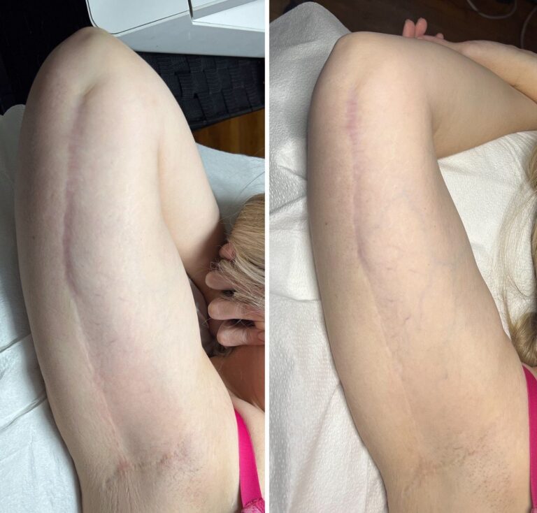 A long surgical scar on the upper arm before, and a flatter, paler scar after microchanneling