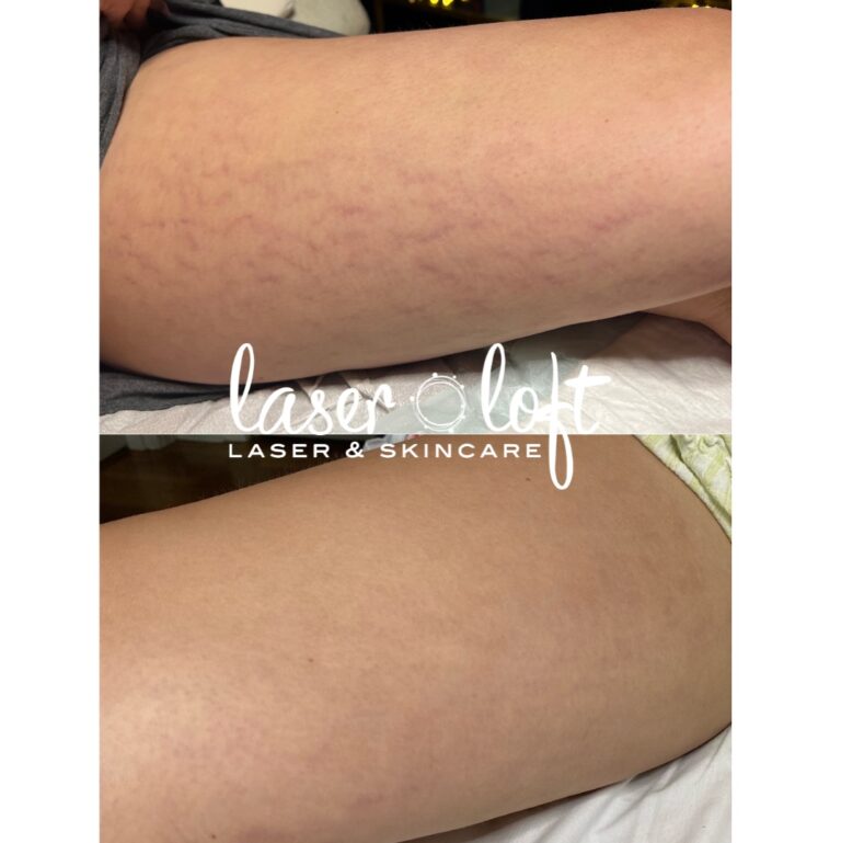 Red stretch marks across the thigh before, and faded, even-toned skin after microchanneling