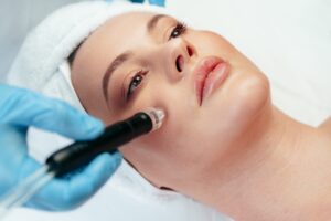 A microchanneling treatment on the face