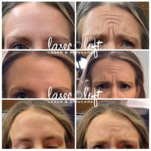 Forehead and frown lines at rest and when frowning before, and a smoother forehead after neurotoxin injections