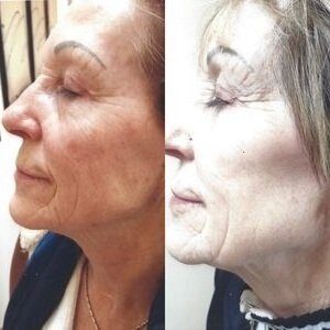 Brown sun spots on the left cheek before, and a clearer, more even skin tone after pigment removal