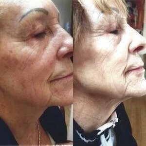 Brown patches on the right cheek before, and lighter, more even skin after pigment removal