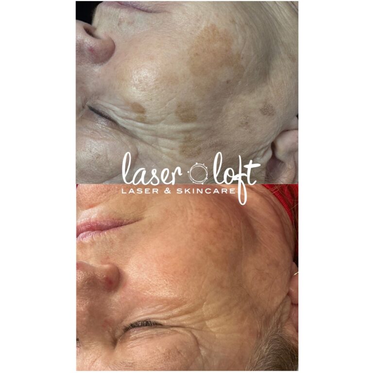 Large brown age spots on the cheek and temple before, and much lighter spots after pigment removal