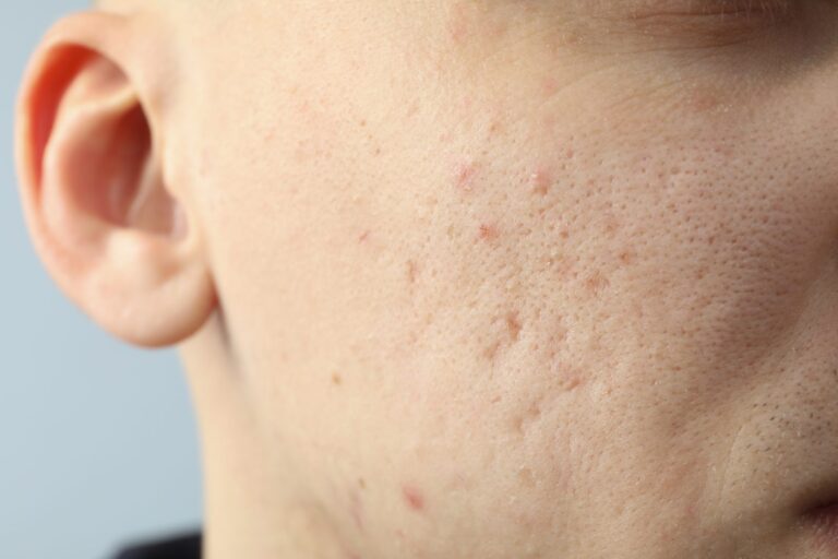 Cheek texture with settled acne scarring