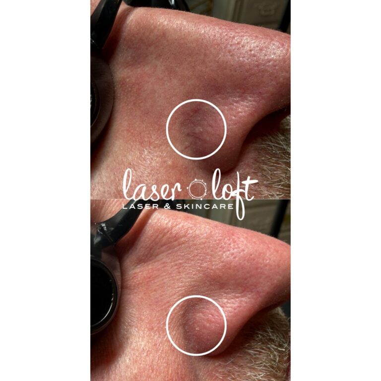 Circled spider veins on the side of the nose before, and clear skin in the same spot after laser vein removal