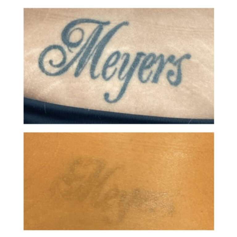 Script name tattoo on the lower back before and after laser tattoo removal