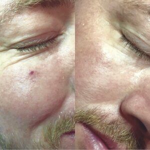 A cherry angioma, a small red dot below the eye, before, and clear skin after laser treatment