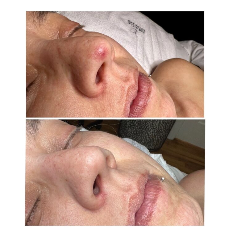 A red, raised spot on the side of the nose before, and clear skin after laser vein removal