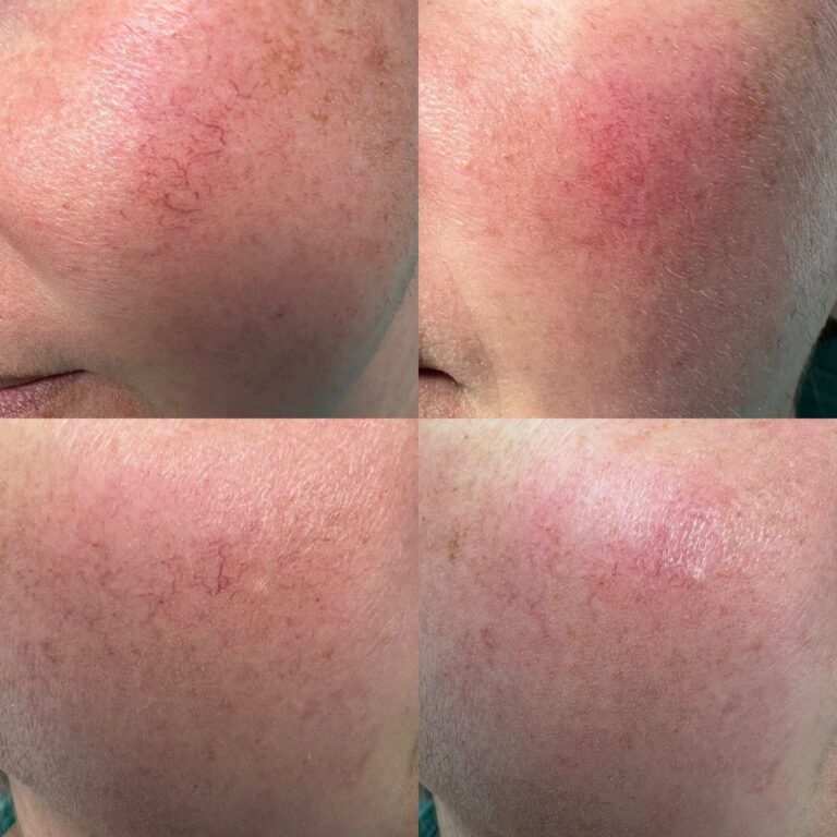 Fine red thread veins across the cheek before, and fewer, fainter veins after laser vein removal