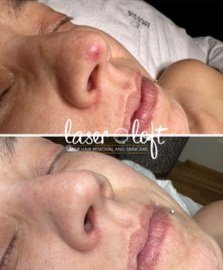 Angled view of a small red spot beside the nostril before, and the spot gone after laser vein removal