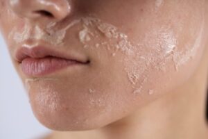 Light flaking on a cheek during peel week